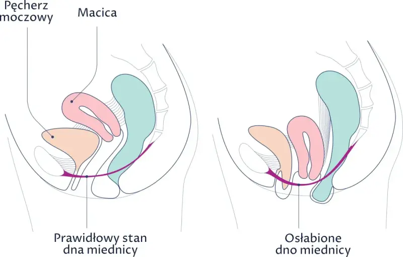 Ilustracja porównuje prawidłowy i osłabiony stan dna miednicy. Wypadająca macica objawy mogą być widoczne przy osłabieniu mięśni.