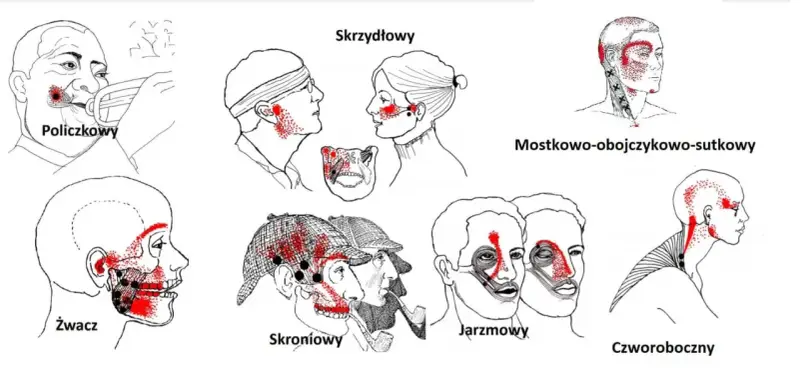 Punkty spustowe bólu w obrębie głowy i szyi, w tym mięsień skrzydłowy.